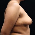 Breast Asymmetry Before & After Patient #10901