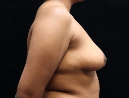 Breast Asymmetry Before & After Patient #10901
