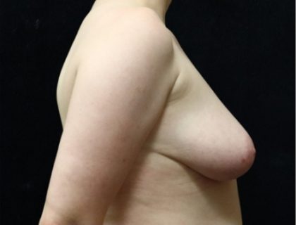 Breast Asymmetry Before & After Patient #10902