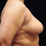 Breast Asymmetry Before & After Patient #10903