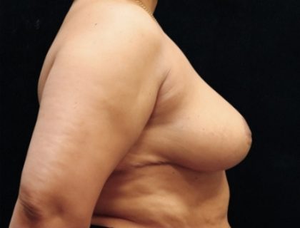 Breast Asymmetry Before & After Patient #10903