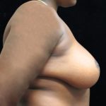 Breast Asymmetry Before & After Patient #10905