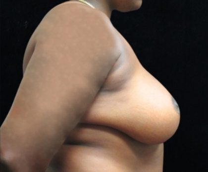 Breast Asymmetry Before & After Patient #10905