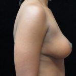 Breast Lift Before & After Patient #11044