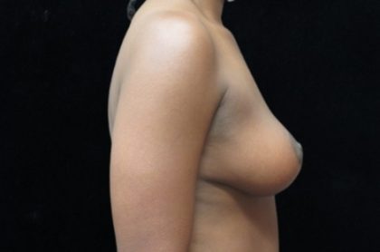 Breast Lift Before & After Patient #11044