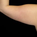 Arm Lift Before & After Patient #10812