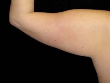 Arm Lift Before & After Patient #10812