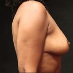 Breast Lift Before & After Patient #11046