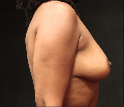 Breast Lift Before & After Patient #11046