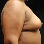 Breast Lift Before & After Patient #11049