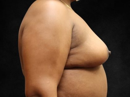 Breast Lift Before & After Patient #11049