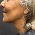 Scarless Facelift and Necklift Before & After Patient #11100