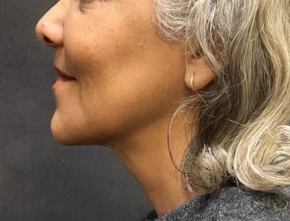 Scarless Facelift and Necklift Before & After Patient #11100