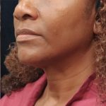 Scarless Facelift and Necklift Before & After Patient #11101