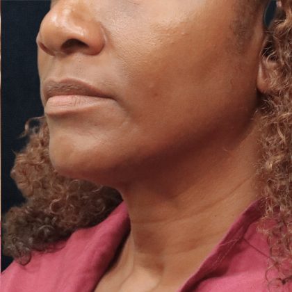 Scarless Facelift and Necklift Before & After Patient #11101