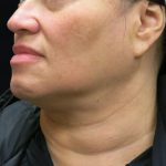 Scarless Facelift and Necklift Before & After Patient #11102