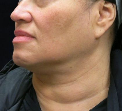 Scarless Facelift and Necklift Before & After Patient #11102