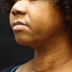 Scarless Facelift and Necklift Before & After Patient #11104