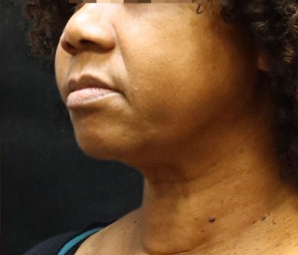 Scarless Facelift and Necklift Before & After Patient #11104