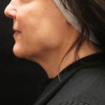Scarless Facelift and Necklift Before & After Patient #11105
