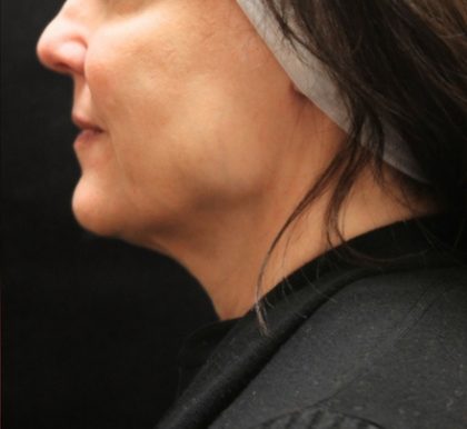 Scarless Facelift and Necklift Before & After Patient #11105