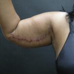 Arm Lift Before & After Patient #10813
