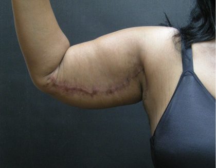 Arm Lift Before & After Patient #10813