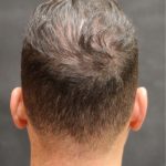 Hair Restoration Before & After Patient #11146