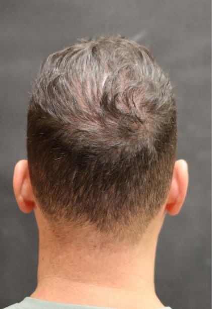Hair Restoration Before & After Patient #11146