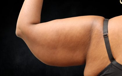 Arm Lift Before & After Patient #10814