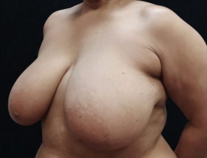 Breast Asymmetry Before & After Patient #10903