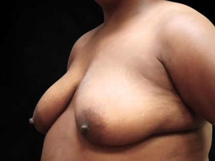 Breast Lift Before & After Patient #11049