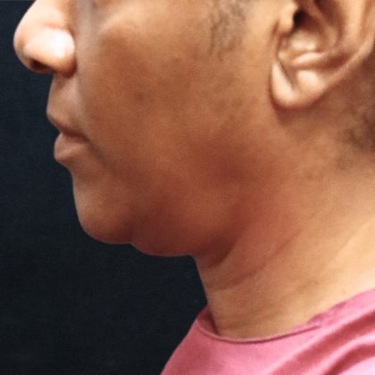Scarless Facelift and Necklift Before & After Patient #11101