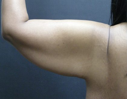 Arm Lift Before & After Patient #10813