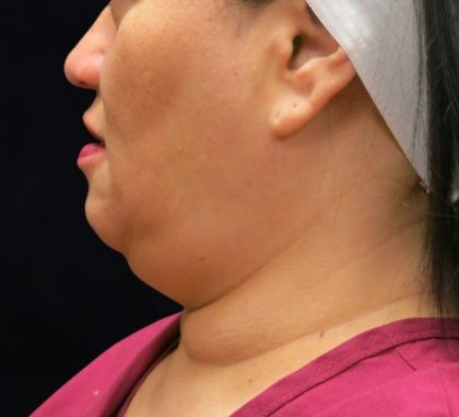 Scarless Facelift and Necklift Before & After Patient #11102