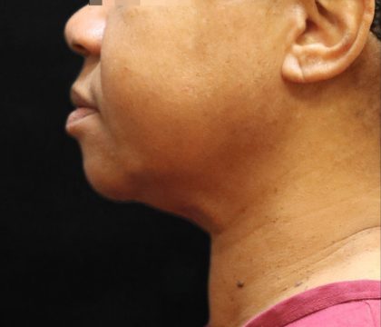 Scarless Facelift and Necklift Before & After Patient #11104