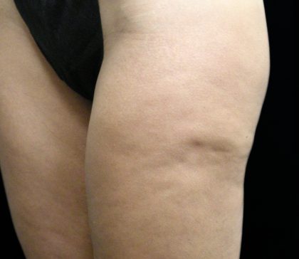 Cellulite Treatment Before & After Patient #10862