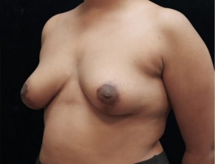 Breast Asymmetry Before & After Patient #10901