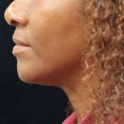 Scarless Facelift and Necklift Before & After Patient #11101