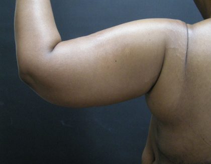Arm Lift Before & After Patient #10813