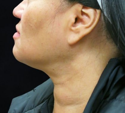 Scarless Facelift and Necklift Before & After Patient #11102