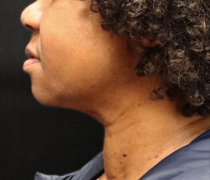 Scarless Facelift and Necklift Before & After Patient #11104