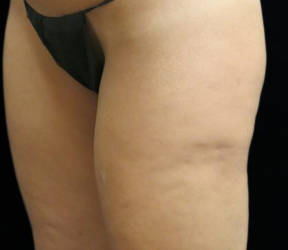 Cellulite Treatment Before & After Patient #10862