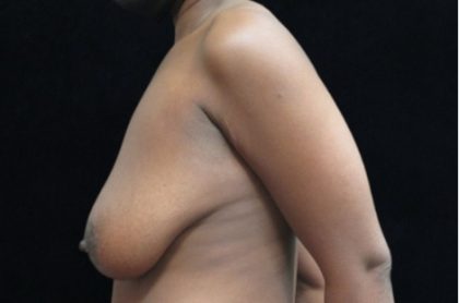 Breast Lift Before & After Patient #11044