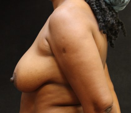Breast Lift Before & After Patient #11046