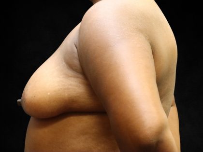 Breast Lift Before & After Patient #11049