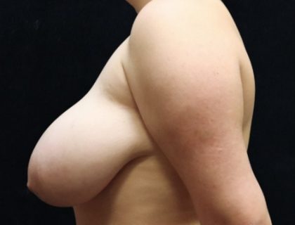 Breast Asymmetry Before & After Patient #10895