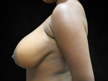 Breast Asymmetry Before & After Patient #10900