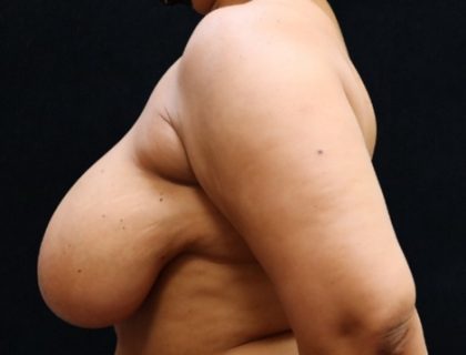 Breast Asymmetry Before & After Patient #10903
