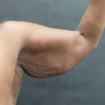 Arm Lift Before & After Patient #10811